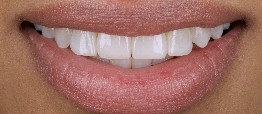 After Invisalign, whitening and edge bonding