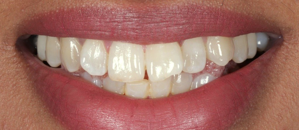 Before the ABC method